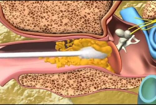 ruptured eardrum