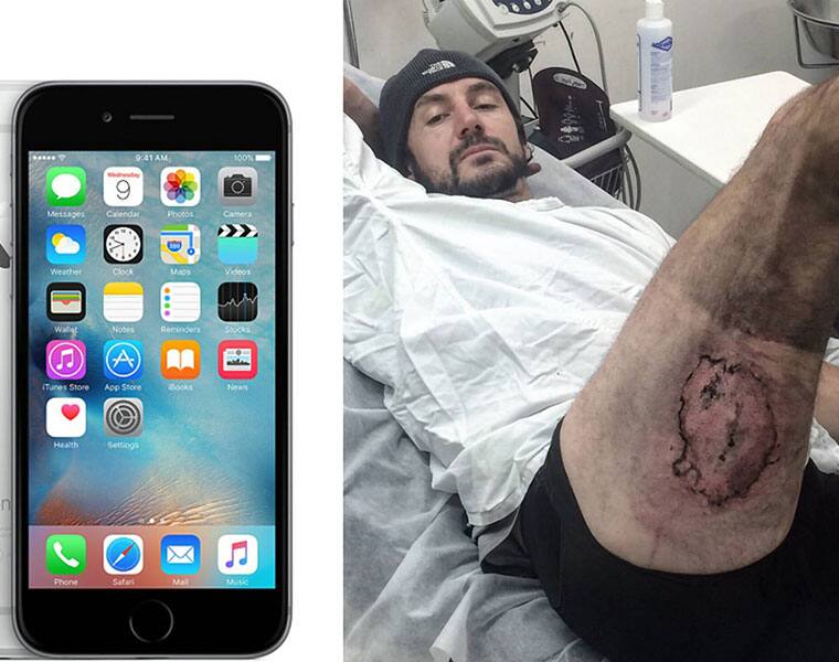 Man severely injured when iPhone 6 explodes in his back pocket