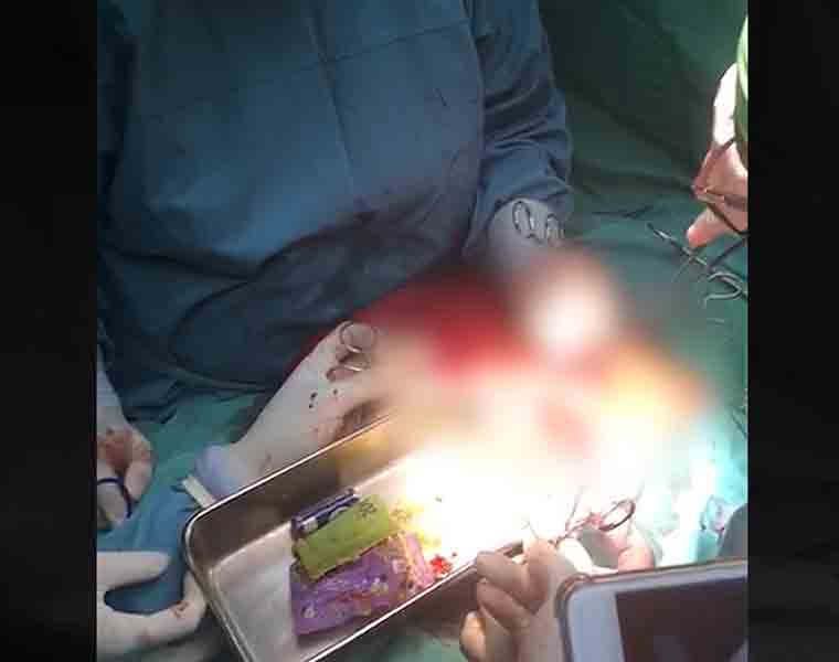 Doctors operate on 4-year-old child and find battery, lighter, plastic in the stomach