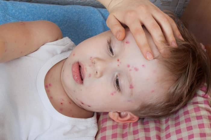 6744 chickenpox cases, 9 deaths in 75 days in Kerala Rya