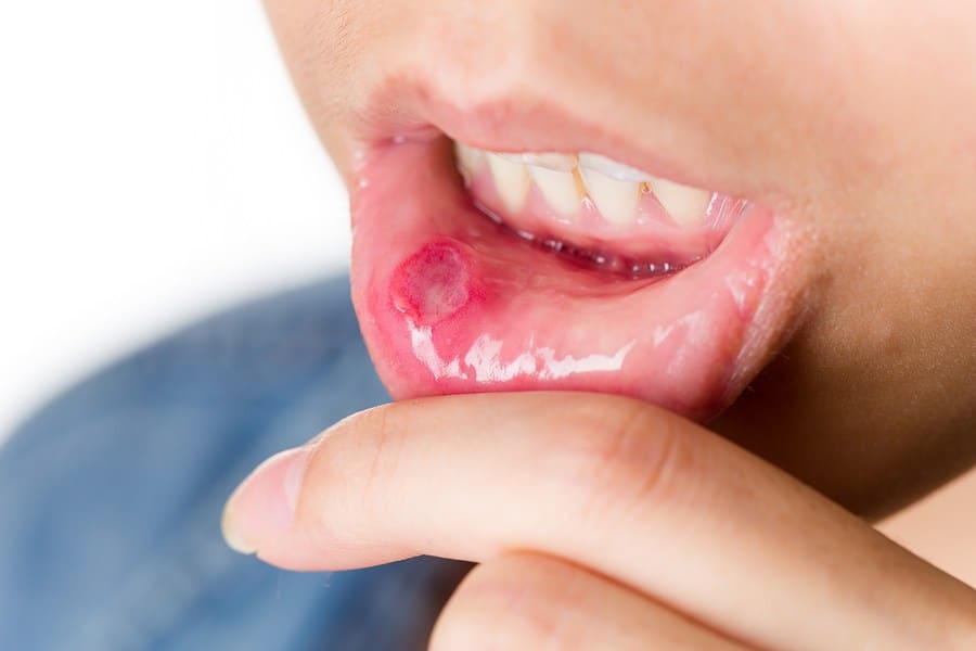 how to get rid of mouth ulcers at home