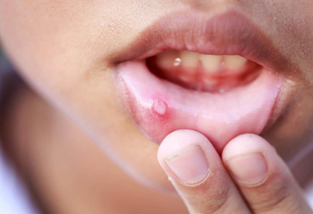 Do you often suffer from mouth ulcers? Here are some grandmother remedies!