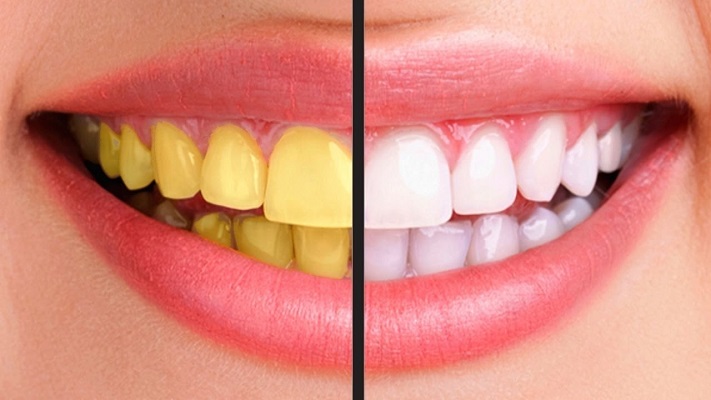 Reason behind yellow teeth