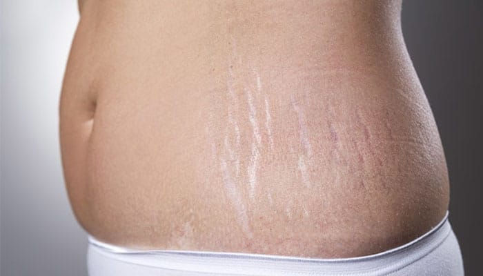 tips to avoid stretch marks after pregnancy