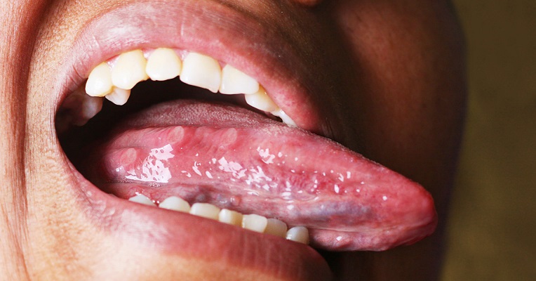 What your tongue says about your health