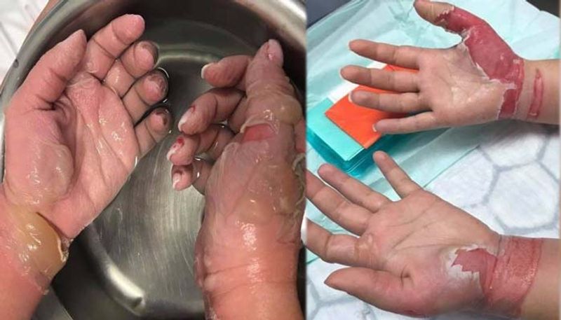 girl got third degree burn while using nail polish remover