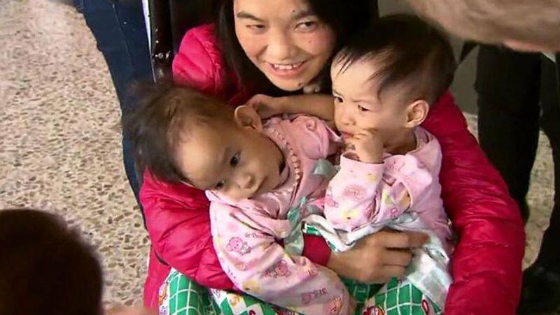 Conjoined twin babies... six-hour surgery