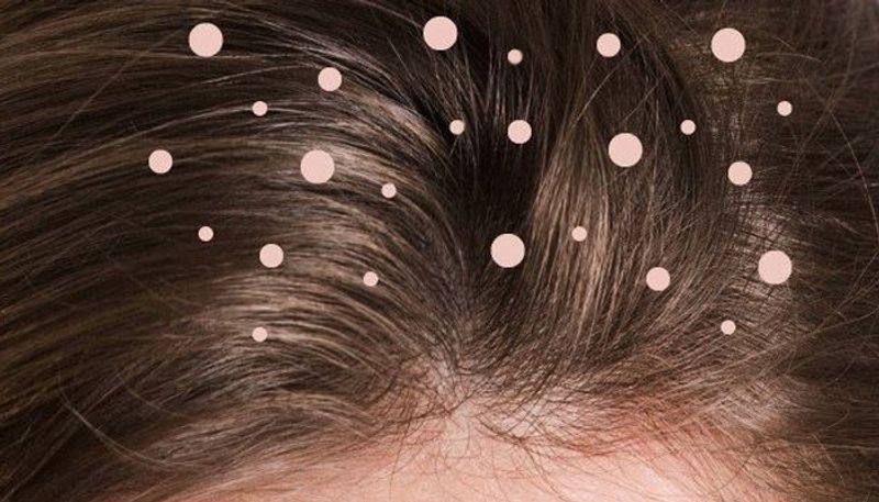 Effective natural ways to prevent dandruff