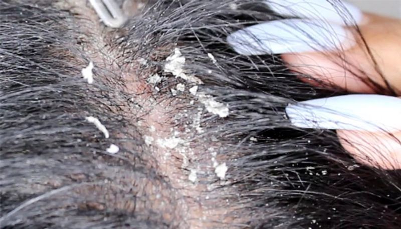 effective natural method to prevent dandruff