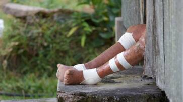 World Leprosy Day India battling over 1 lakh cases WHO eliminating prejudice