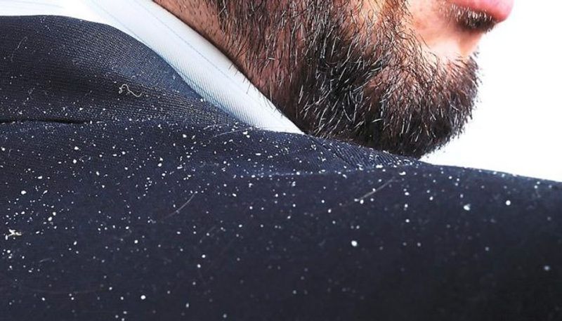 Remedies to get rid of dandruff