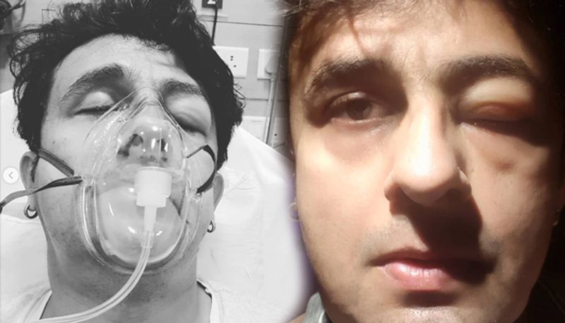 Sonu Nigam in ICU after food allergy