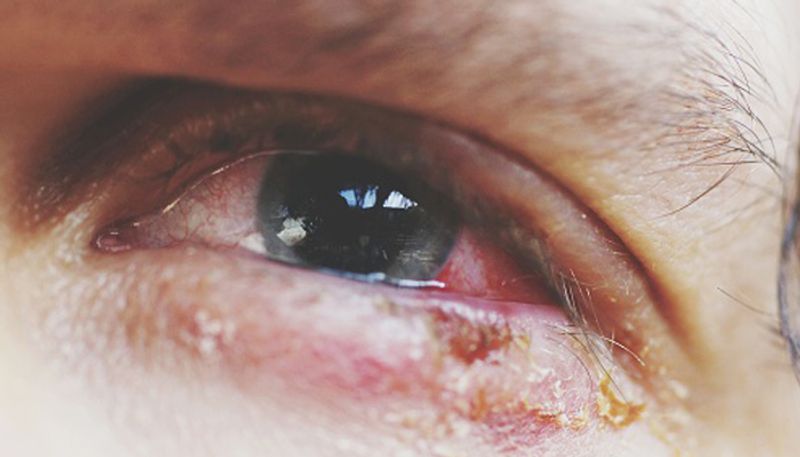 Pink eye stares people of Bengaluru in the face this summer, number of cases increases steadily