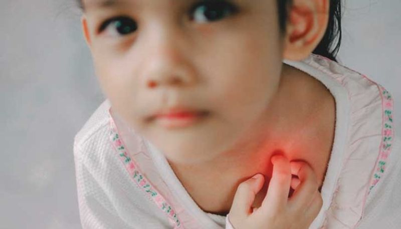 Heat rash is an itchy rash that mostly affects children warning