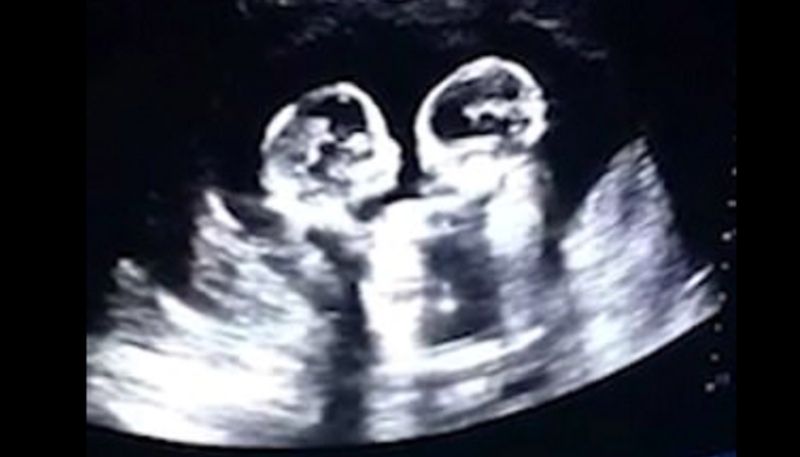 Identical twin sisters spotted 'fighting' in their mother's womb