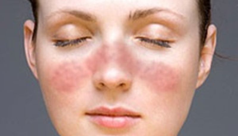 world lupus day symptoms causes treatment 