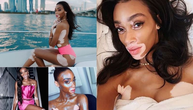 Winnie Harlow is an inspiration to all women