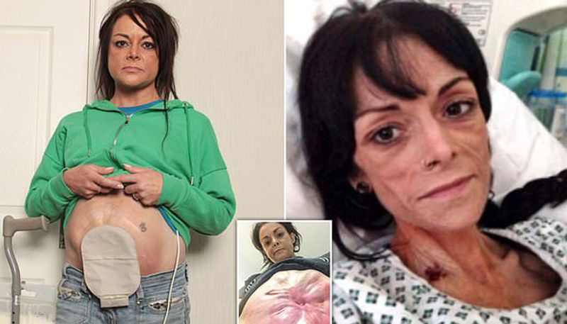 mother whose insides began to burst through her caesarean section scar