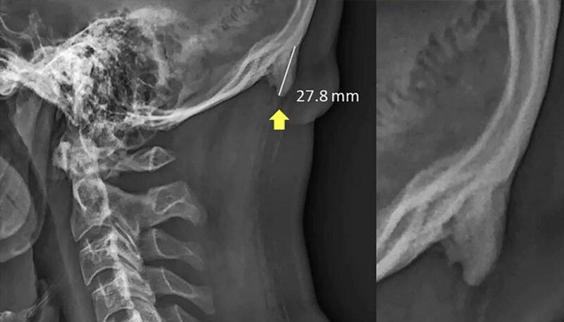 Horns Are Growing on Young People s Skulls Due to Phone Use