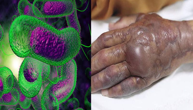 Deadly flesh eating bacteria is spreading to new areas because of climate change