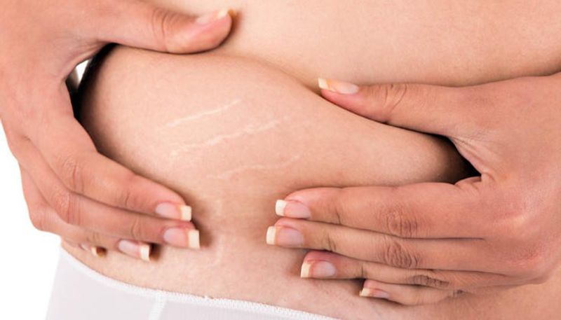 tips for remove stretch marks