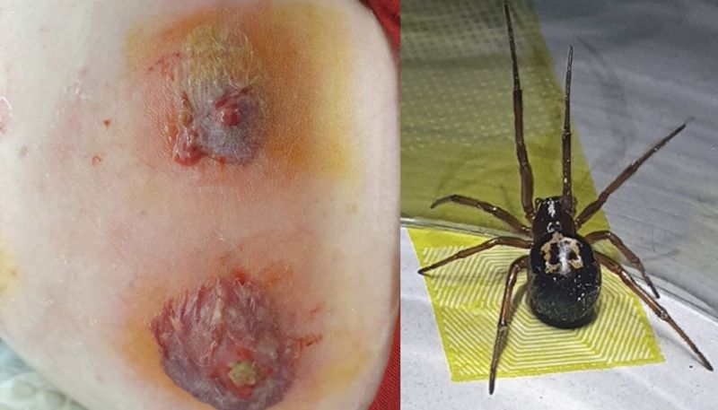 false widow spider bite left youth unable to walk