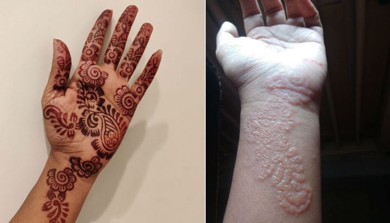 woman shares her experience after chemical added mehandi made burns in her hand