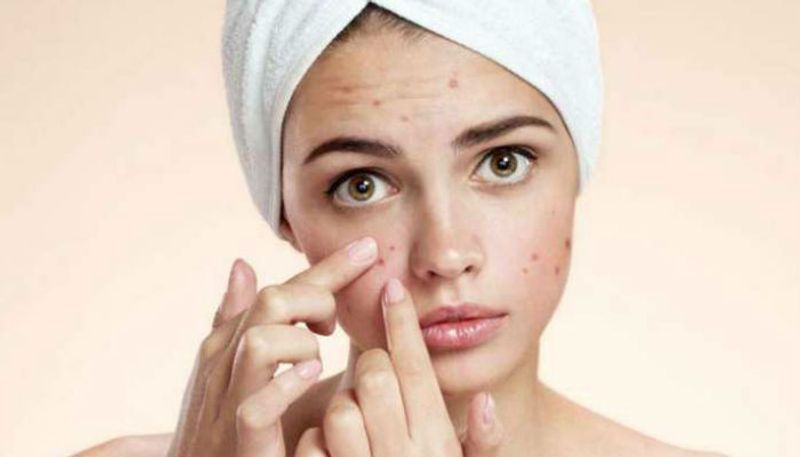 Know the causes and treatment of adult acne