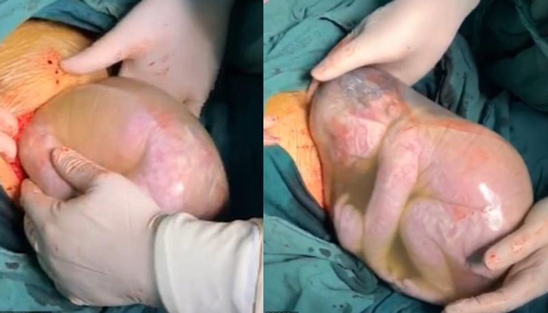 Bubble Boy born floating inside intact amniotic sac rare surgery saves mother and child