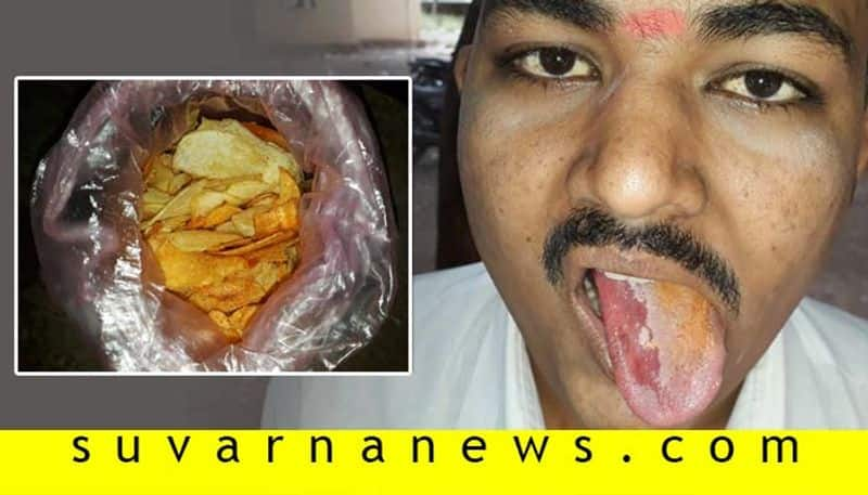 Youth Tongue Burns After Eating Chemical Mixed Chips In Vijayapura