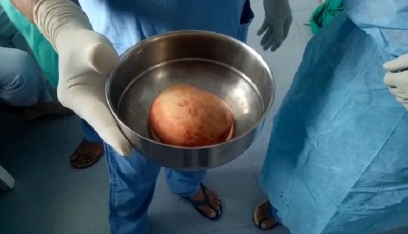 biggest kidney stone ever removed through successful surgery