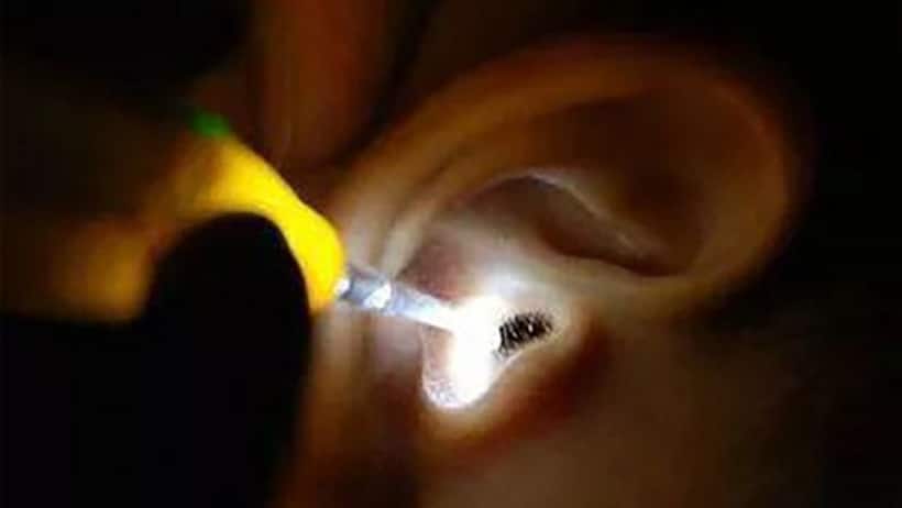 Doctor pulls out live cockroach from woman’s ear