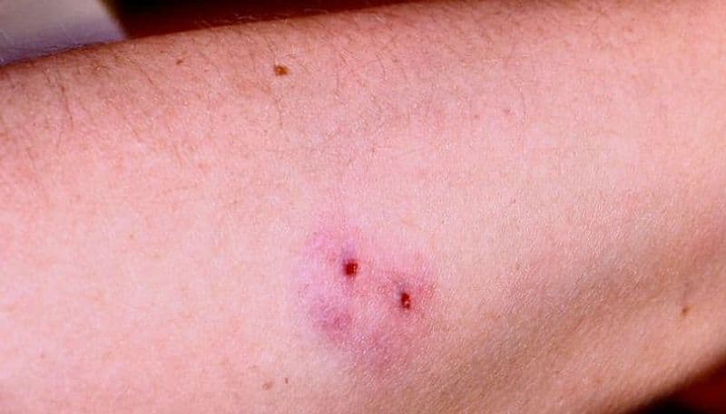 symptoms of snake bite and immediate treatment