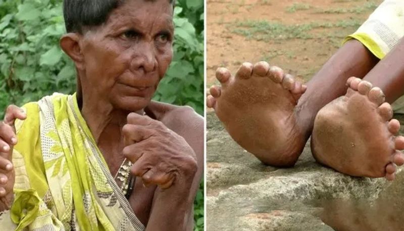 Woman born with rare medical condition 12 fingers and 20 toes branded as witch by neighbours