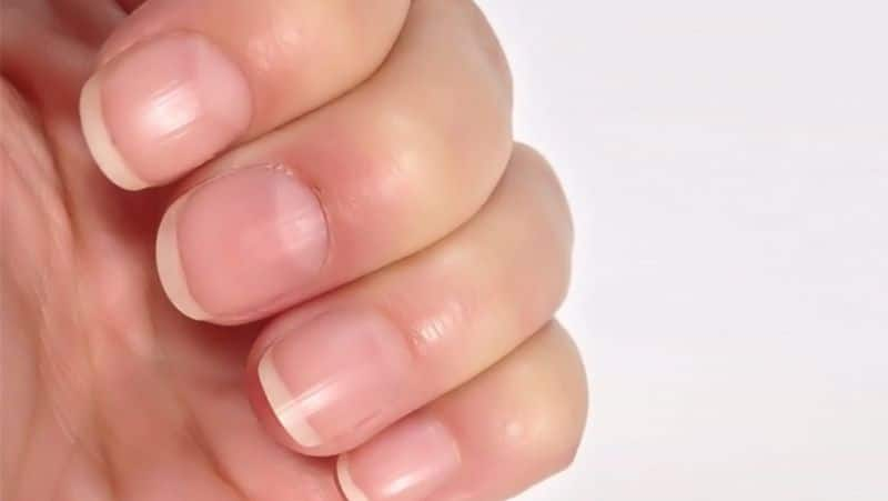 what does it mean to have white marks on nails rsl