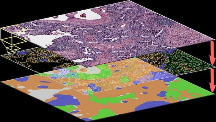 Research : अब आर्टिफिशियल इंटेलिजेंस के जरिए कैंसर सेल्स की पहचान होगी संभव