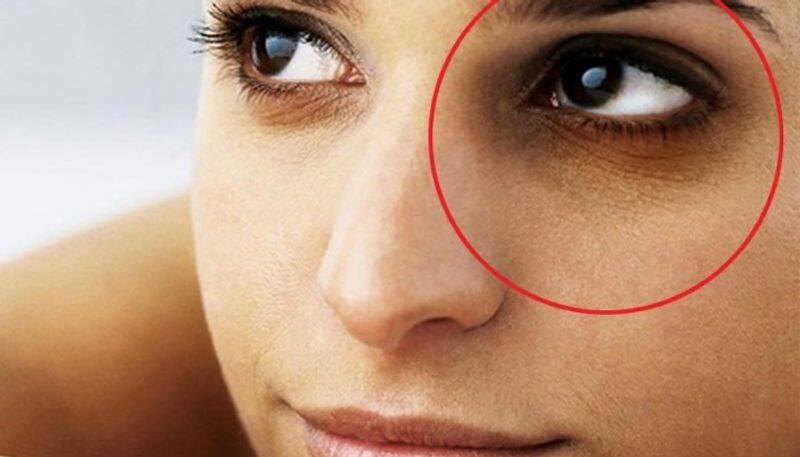 Tips to get ride of eye bags and dark circles