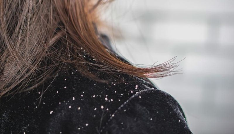 how to get rid of dandruff