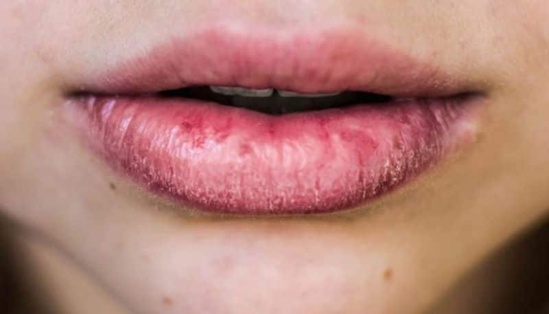 Dry lips in winter? Here are some great tips for you!