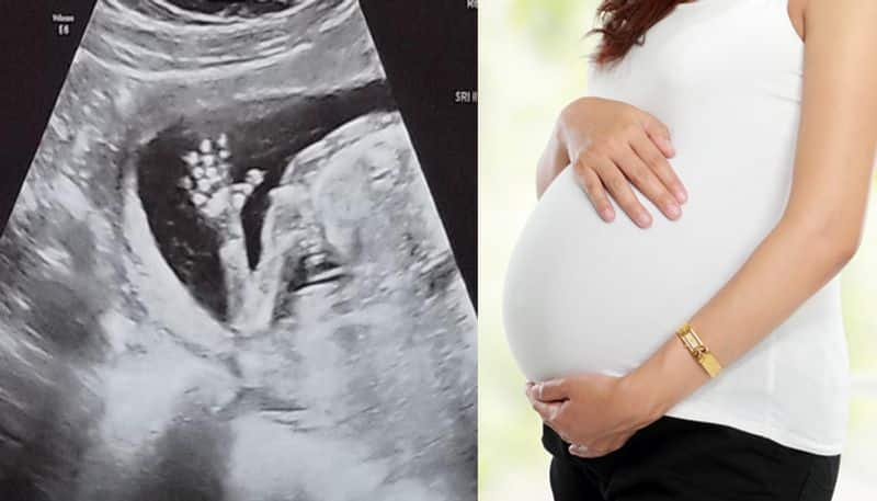 Woman shocked to discover she has tWO vaginas and tWO wombs during routine 10 week ultrasound