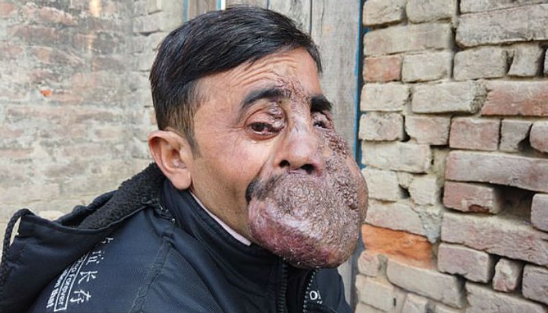 man with big  tumour on face worshipped by natives