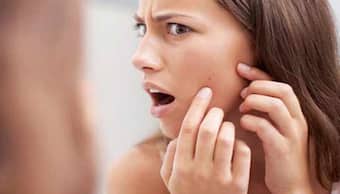Acne break out: Home remedies that can help reduce zits and prevent acne scars