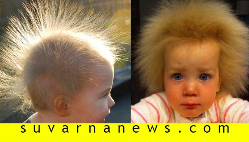 what causes Uncombable Hair Syndrome Is Real