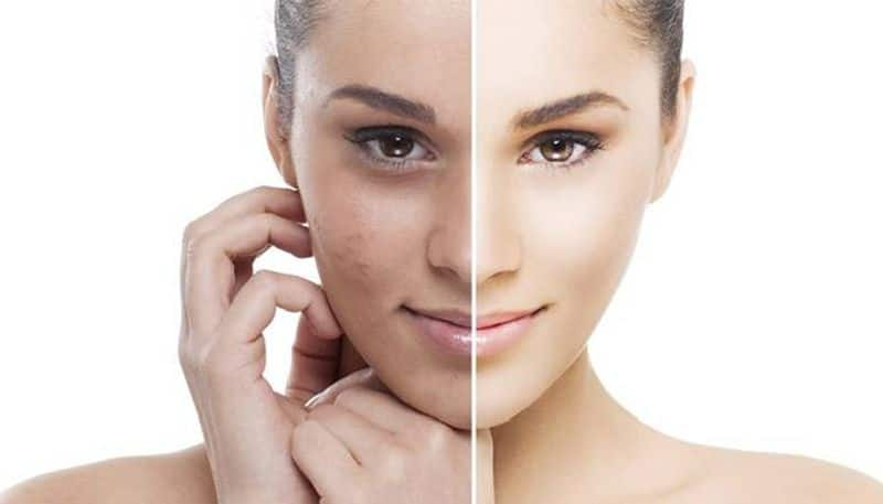 Home Remedies To remove Dark spots on face