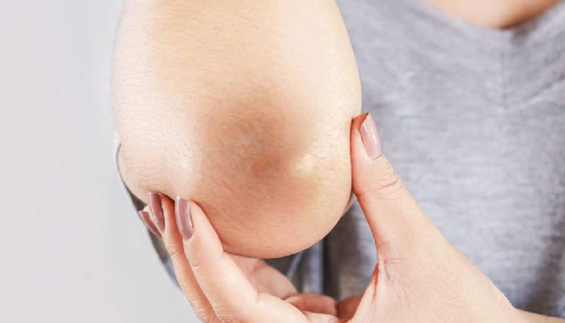 How to get rid of dark elbows and knees naturally