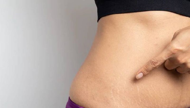 how to get rid of stretch marks