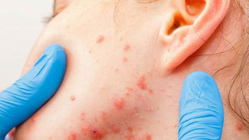 Coronavirus: Allergy care does not stop with COVID 19; here’s what you should do
