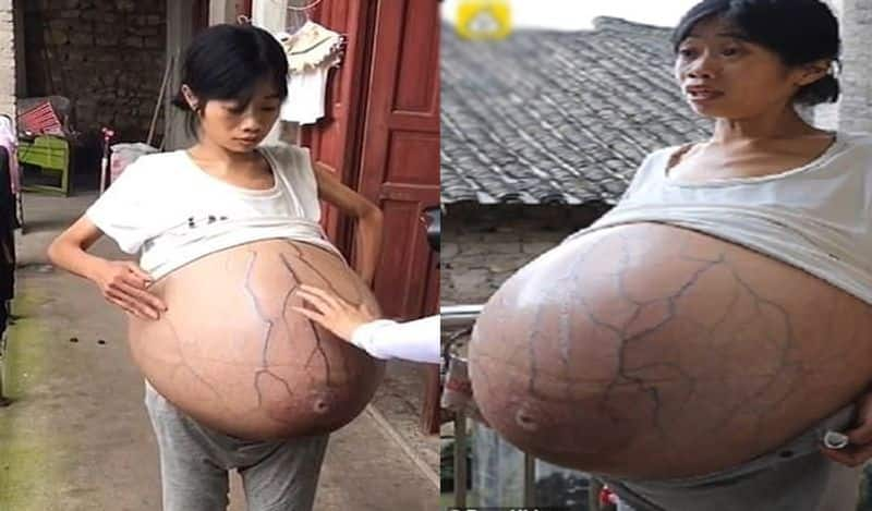 Woman belly grows 'uncontrollably', weighs 19 kg due to medical condition