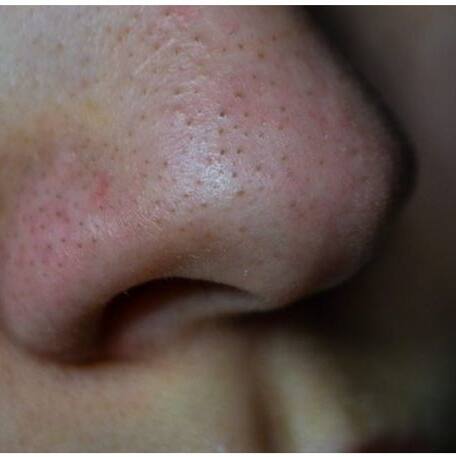 Blackheads: ఇదొక్కటి రాసినా ముఖంపై బ్లాక్ హెడ్స్ ఉండవు..!