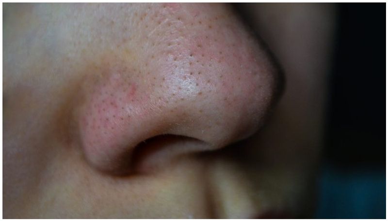 home remedies for blackheads on nose 